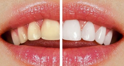 بليچينگ یا سفید کردن دندان