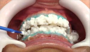 سفید کردن دندان با مواد بلیچینگ