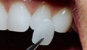 سفید کردن دندان با لمینیت کامپوزیت