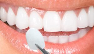سفید کردن دندان با ونیر کامپوزیت