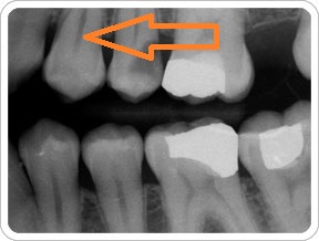 تشخیص پوسیدگی دندان از روی عکس