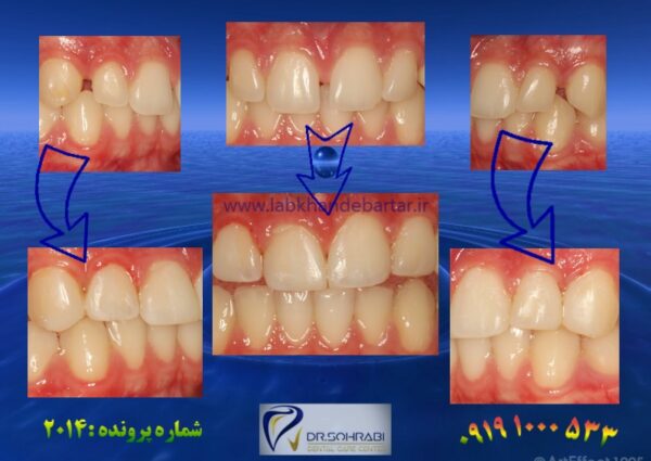 بستن فاصله دندانی 2014