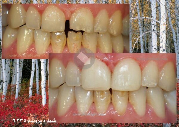 بستن فاصله دندان های قدامی با کامپوزیت6235