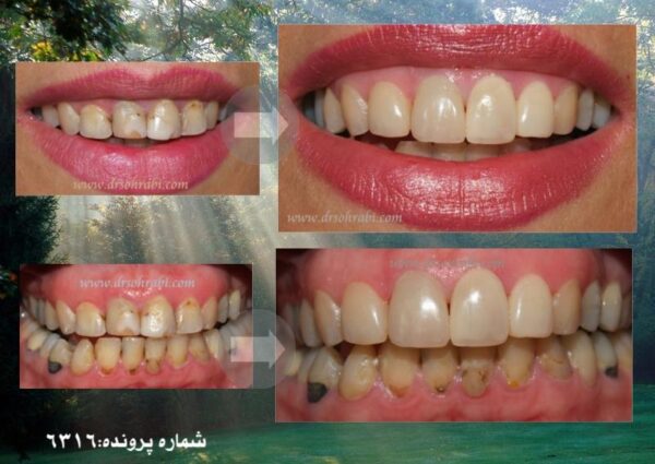 بازسازی کامل دندان با کامپوزیت