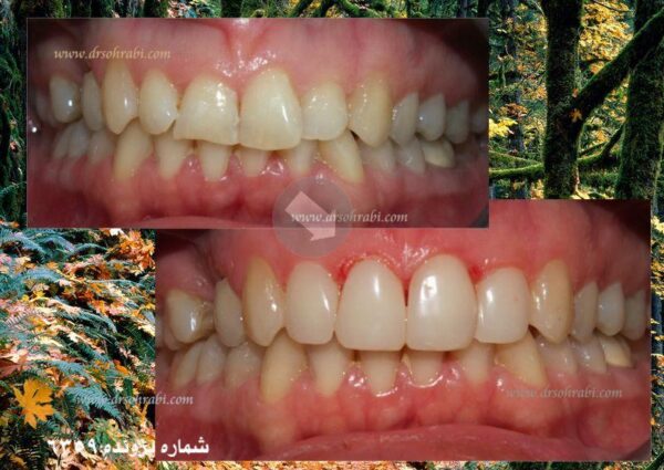 اصلاح شکل دندانی بدون تراش