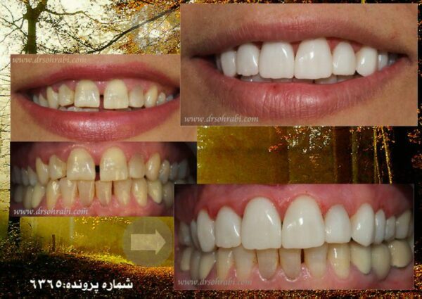 بستن فاصله بین دندان ها با کامپوزیت و تغییر رنگ دندان ها6365
