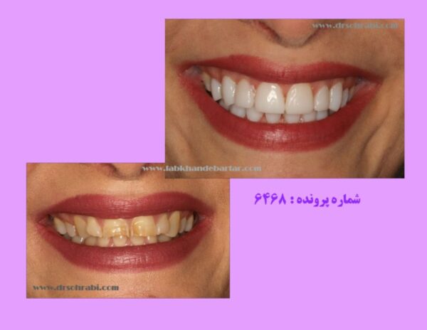 ونیر کامپوزیت 6468 : فیسینگ دندان های دو فک توسط کامپوزیت