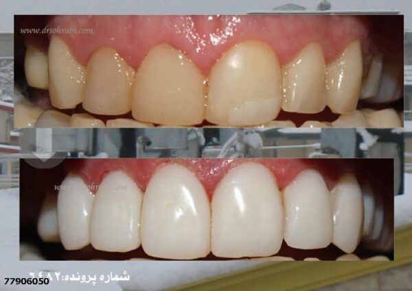 ونیر کامپوزیت و ایمپلنت در نواحی خالی دندان
