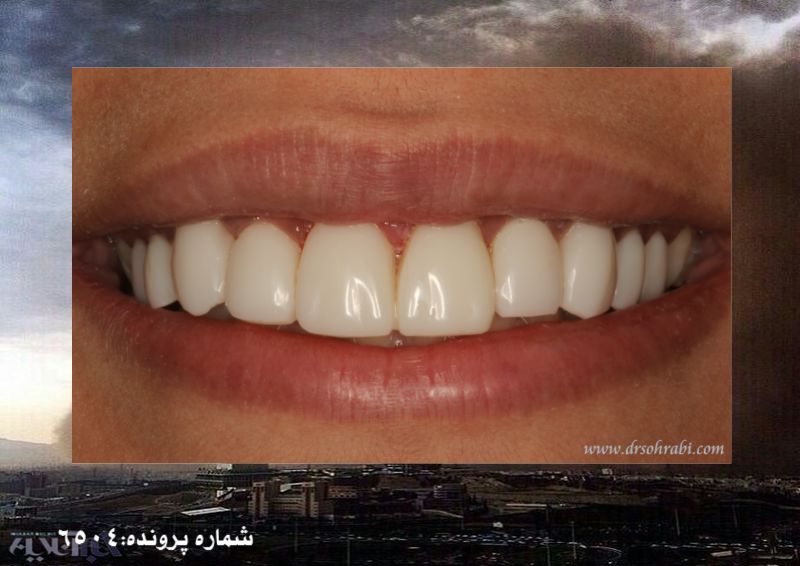 اصلاح بد رنگی و بد شکلی دندان ها با لامینیت کامپوزیت