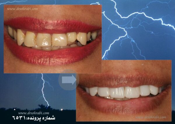 اصلاح بد رنگی و بد شکلی دندان ها با لامینیت کامپوزیت : شماره پرونده6531
