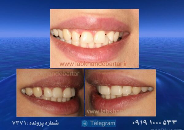 نمونه کار از درمان دیاستم دندانی