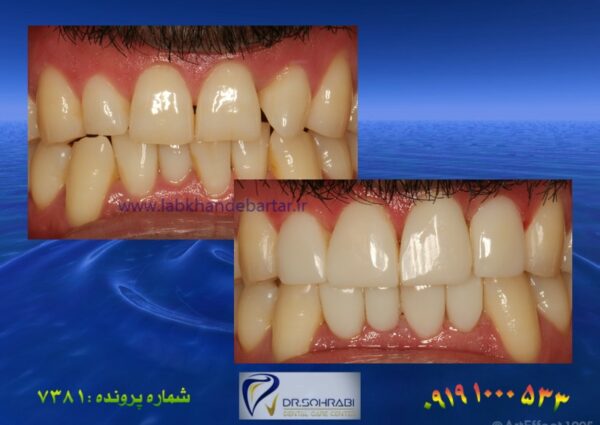 اصلاح نامرتبی دندان