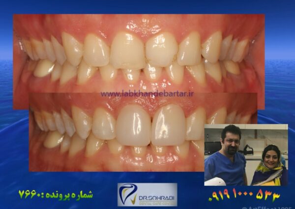 اصلاح شکل دندان