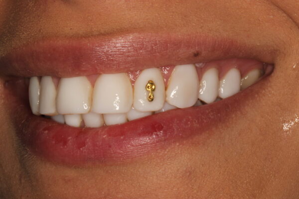 نگین طلای دندان