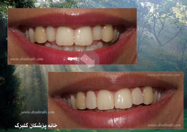 درمان نا مرتبی و شلوغی دندان ها