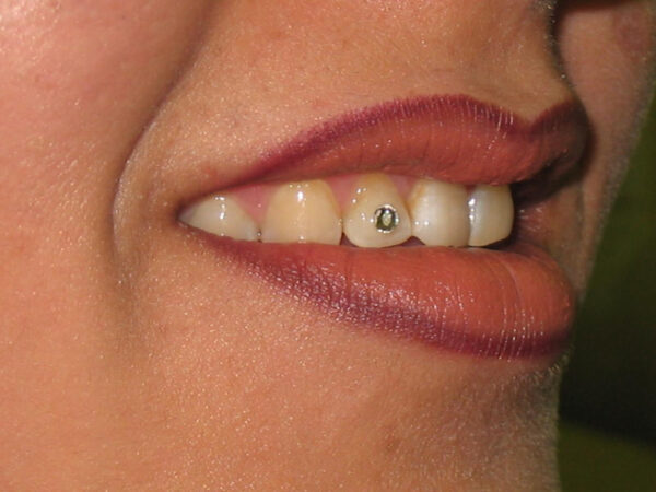 نگین دندان 6000