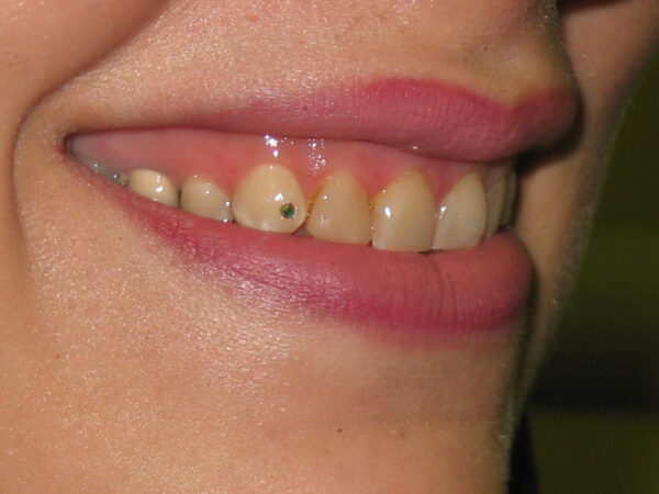 نگین دندان 9 نگین کریستالی ساده دندان